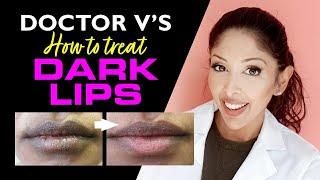 DOCTOR V- How to Treat Lip Hyperpigmentation/ Dark Lips| BROWN/DARK SKIN lip pigmentation treatment