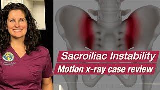 Motion X-ray Can Tell Us a Lot About a Patient's Sacroiliac Joint Instability