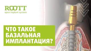 Базальная имплантация зубов. Использование метода базальной имплантации зубов в клинике ROOTT Москва
