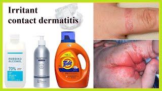 irritant contact dermatitis