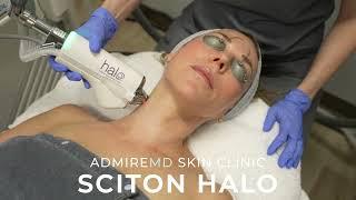 Benefits of Sciton HALO - AdmireMD Skin Clinic