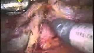 Prostate Cancer Surgery