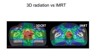 Radiotherapy for Localized Prostate Cancer