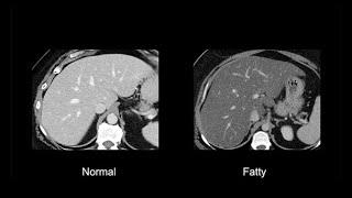 Evaluating the liver with abdominal CT