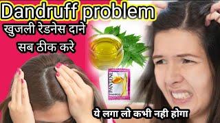 Dandruff Clean Karen 10 Minut Mein||डैंड्रफ कैसे ठीक करें होमरिमेडी सिर्फ 10 मिनट में ठीक करें