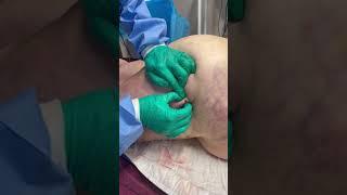 LIPEDEMA NODULES & MANUAL EXTRACTION | Dr. Wright St. Louis MO