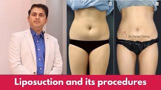 What is Liposuction? | Ideal Candidate for Liposuction | Liposuction in Mumbai | Dr. Parag Telang