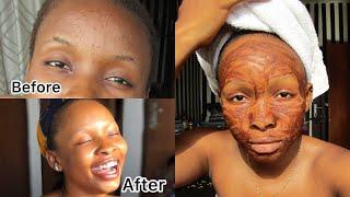 How To Get Rid Of Acne/Pimples In One Week Using CINNAMON Mask