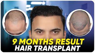 Hair Transplant in Chennai | Best Results & Cost of Hair Transplant in Chennai