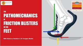 The Pathomechanics of Friction Blisters on the Feet - Blister Prevention