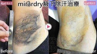 MIRADRY清新微波腋淨爽治療原理、效果、價格費用、代償性、腋下手術 、永久性