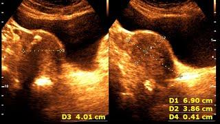 Fatty Liver | Cholelithiasis | Post Covid UTI