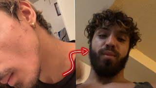 12 MONTH UNBELIEVABLE MINOXIDIL BEARD GROWTH TRANSFORMATION