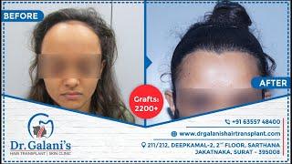 Best Hair Transplant In Surat 2021 | Fue - No Root Touch Surgery | Before And After 2200+ Grafts