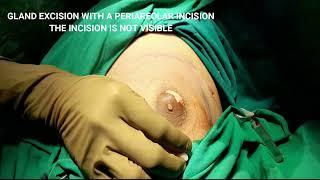 UNILATERAL GYNECOMASTIA SURGERY - LIPOSUCTION AND GLAND REMOVAL (COSMETIC SURGERY) - Dr VICKY JAIN