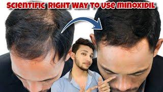 जल्दी Growth के लिए ऐसे लगाओ Minoxidil | Correct Way To Use For Fast Result In Just 30 Days | 100%