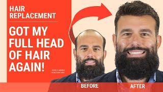 Ready to get His Hair Back! | Hair replacement before and after