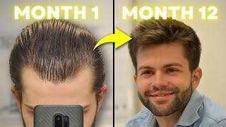 How I Regrew My Hair Using 3 Proven Treatments (Month-by-Month Results) | AL GARRIDO