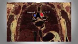 Chest Radiology - Part 1, the Basics of the mediastinum & central structures