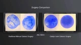 Catalys® Laser Cataract Surgery at Kugler Vision