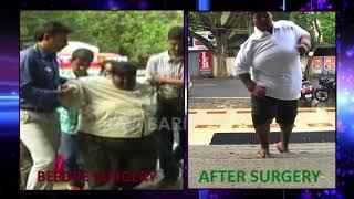 best bariatric surgery results by Dr Ravikanth kongara Hyderabad Vijayawada