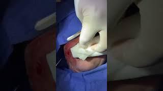 Lip Lift | Dr. Erez Dayan | Avance Plastic Surgery
