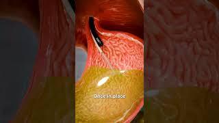 How A Gastric Balloon Works 