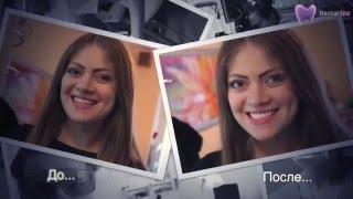 Отбеливание зубов  Zoom-4  в Ростове Центр Dental Spa