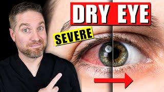 Top Treatments for Severe and Chronic Dry Eyes!