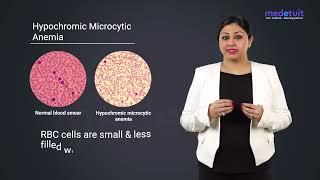 Hypochromic Microcytic Anemia