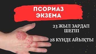 ПСОРИАЗ / ЭКЗЕМА результат / 8708.326.0598 Жанар Сабитовна / Marine Health