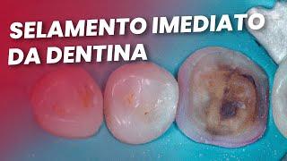 SELAMENTO IMEDIATO DA DENTINA - Mylene e Renato