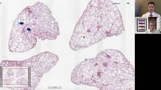 Pulmonary Veno-Occlusive Disease (PVOD) - Deep Dives in Pulmonary Pathology