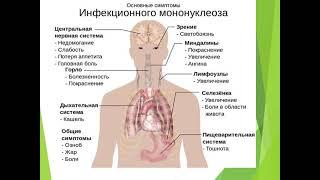 Инфекционный мононуклеоз