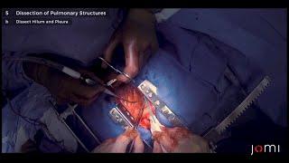 Open Lobectomy (Links to Full Procedure)