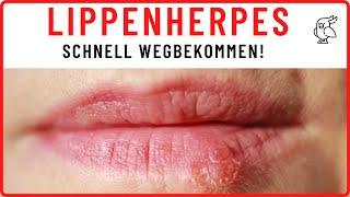 LIPPENHERPES SCHNELL WEGBEKOMMEN! 4 effektive Hausmittel gegen Lippenherpes und Tipps zum Vorbeugen