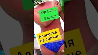 ОЖОГ от солнца Аллергия. Что еще ждать от солнца