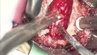 Dr. Casden Performs Anterior Cervical Spine Surgery