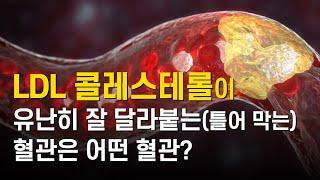 LDL 콜레스테롤에 유난히 잘 막히는 혈관