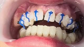 Placing on damon clear ceramic self ligating #braces