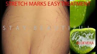 Remove stretch marks easily | Fast  and effective remedy for stretch marks| get rid of stretch marks