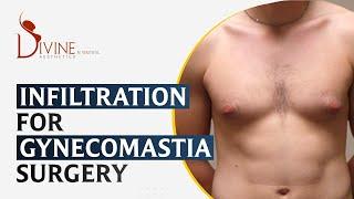 Infiltration For Gynecomastia Surgery