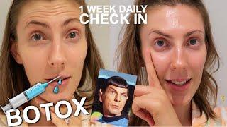 1 Week After Botox - Daily Updates & Results | Spock Brows?? | First time Botox