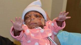 One of World's Smallest Premature Babies Leaves Hospital After Beating Odds