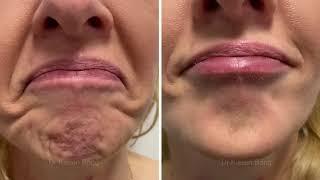 Botox Injections for Dimpled, Uneven, Puckered, Orange Peel Chin