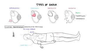 Approach to Shock - types, hypovolemic, cardiogenic, distributive, anaphylaxis, pathology, treatment