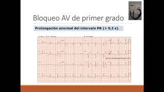 VIDEOCONFERENCIA ARRITMIAS PARTE 1