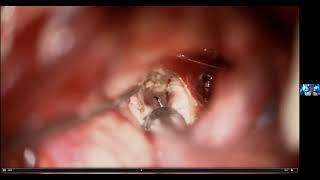 Surgery for Brainstem Cavernous Malformations by Michael Lawton MD of Barrows Neurological Institute