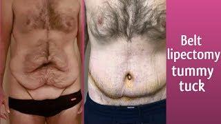 Tummy Tuck (Belt Lipectomy) Story in Thailand!