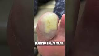 PLANTAR WARTS TREATMENT! #shorts #short